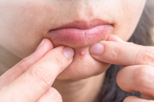 What Your Pimples Say About Your Health