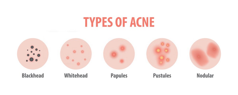 Acne Types