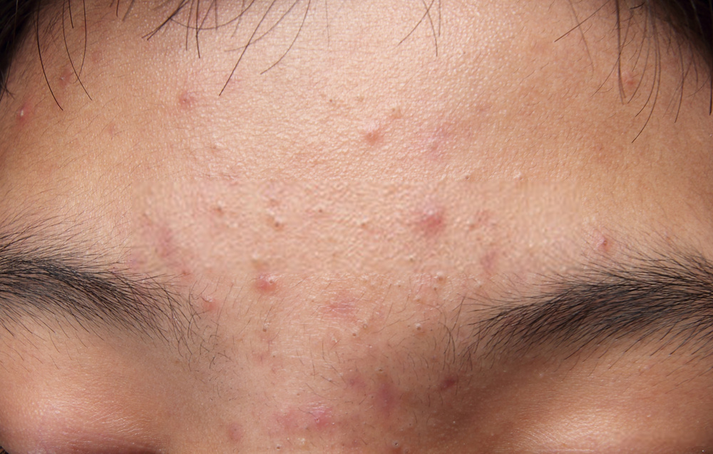 Forehead Acne Face Map