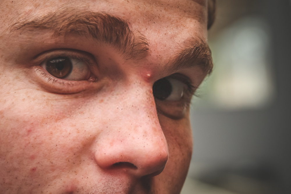 Between the Eyebrows Acne Face map