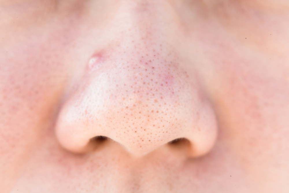 Nose Acne Face Map