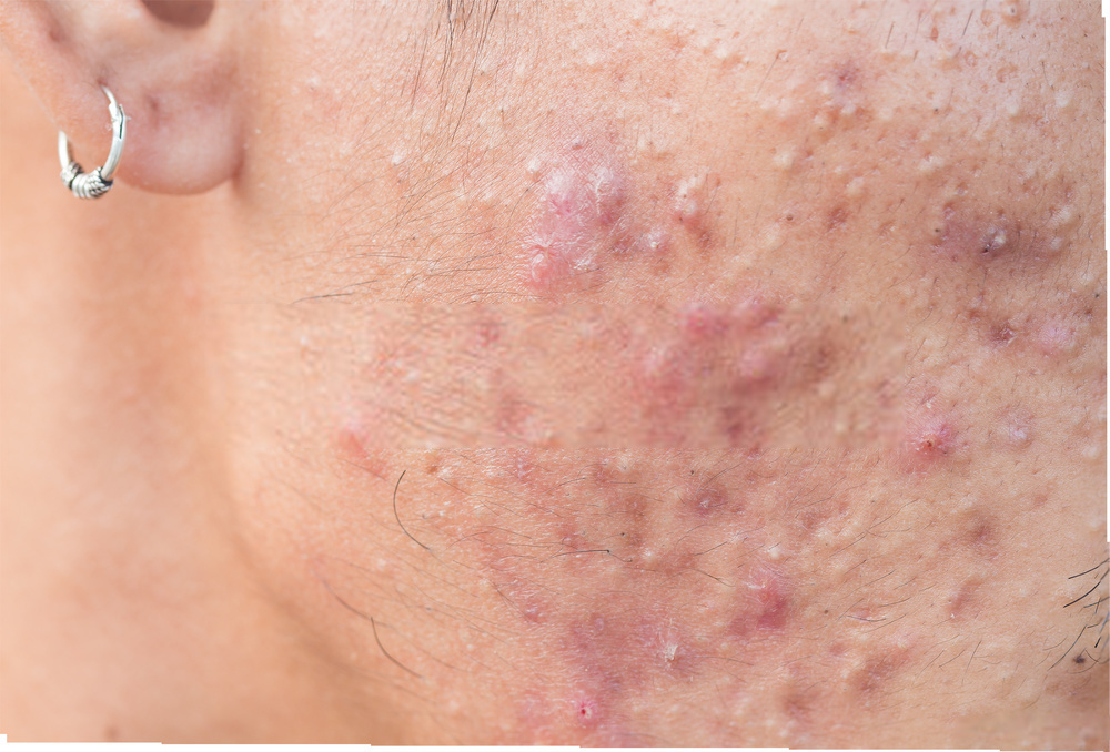 Right Cheek Acne Face Map