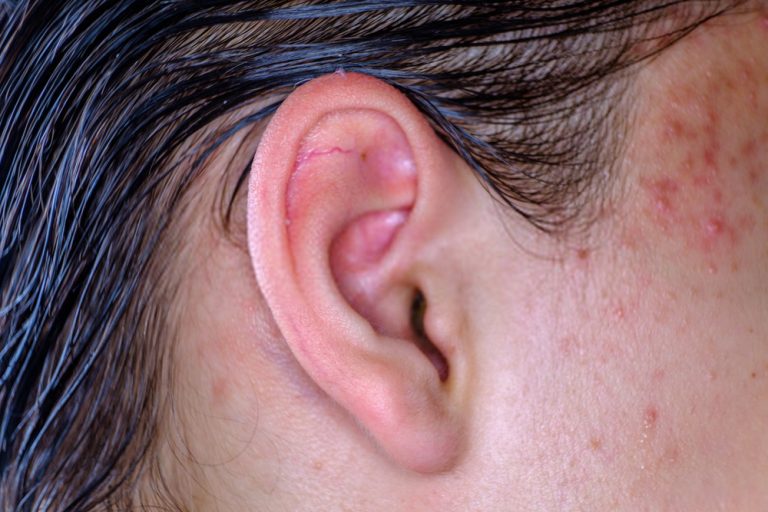 home remedies for pimple inside ear
