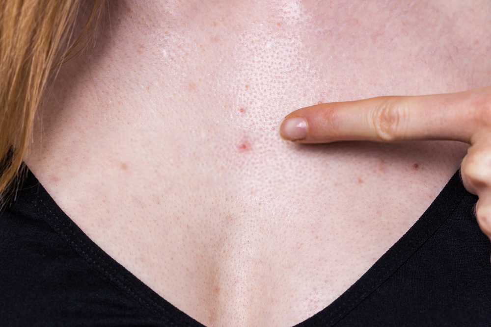 Reasons For Chest Acne