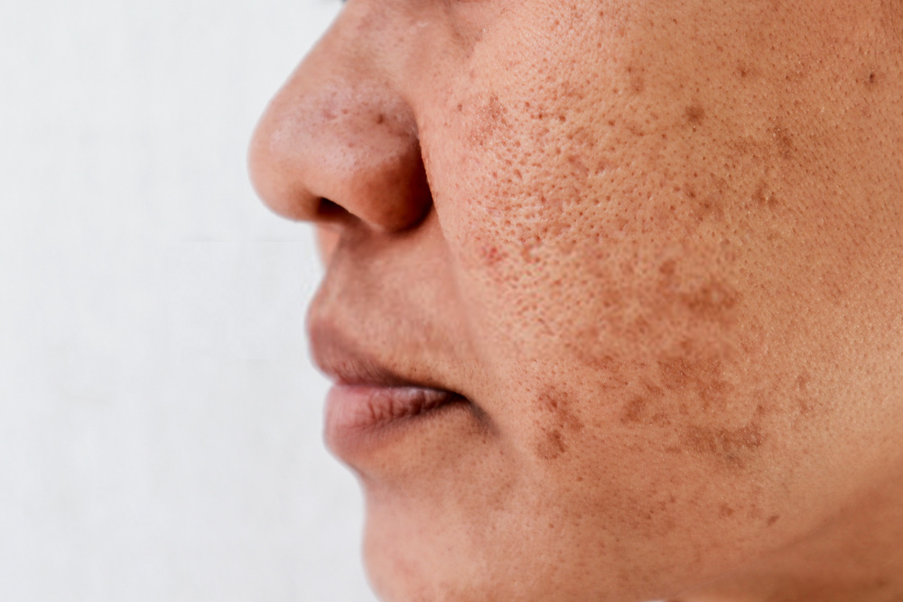 Dark Spots on Face Causes