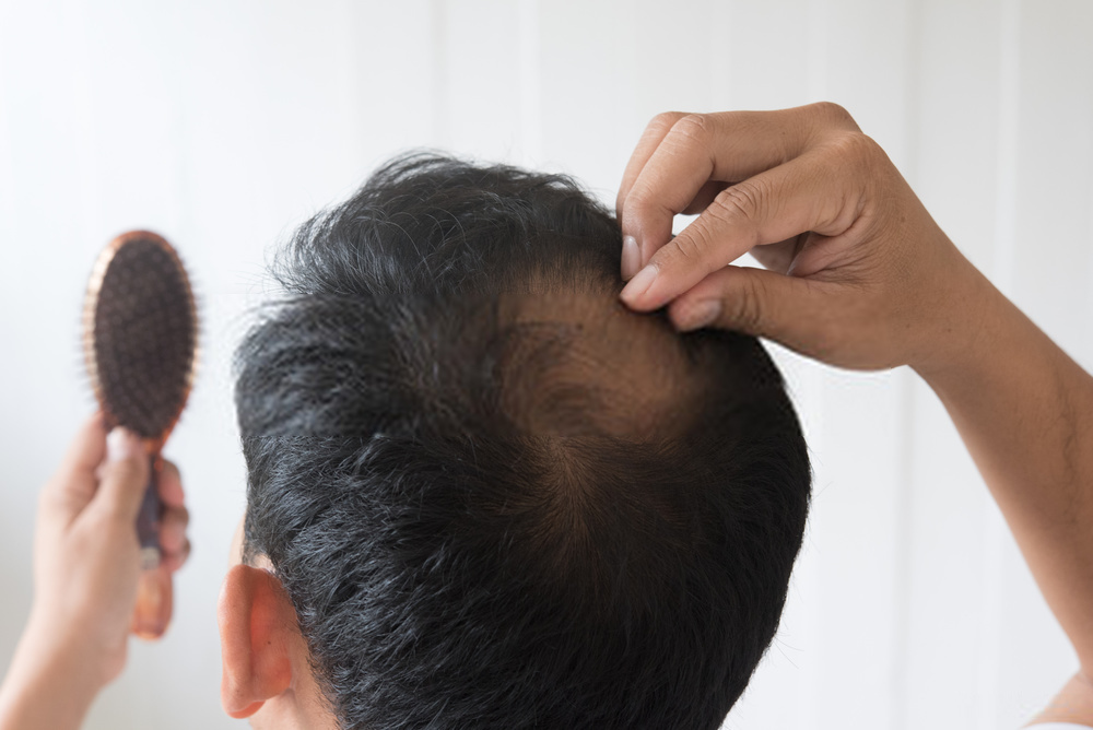 Hair Fall in Men Causes