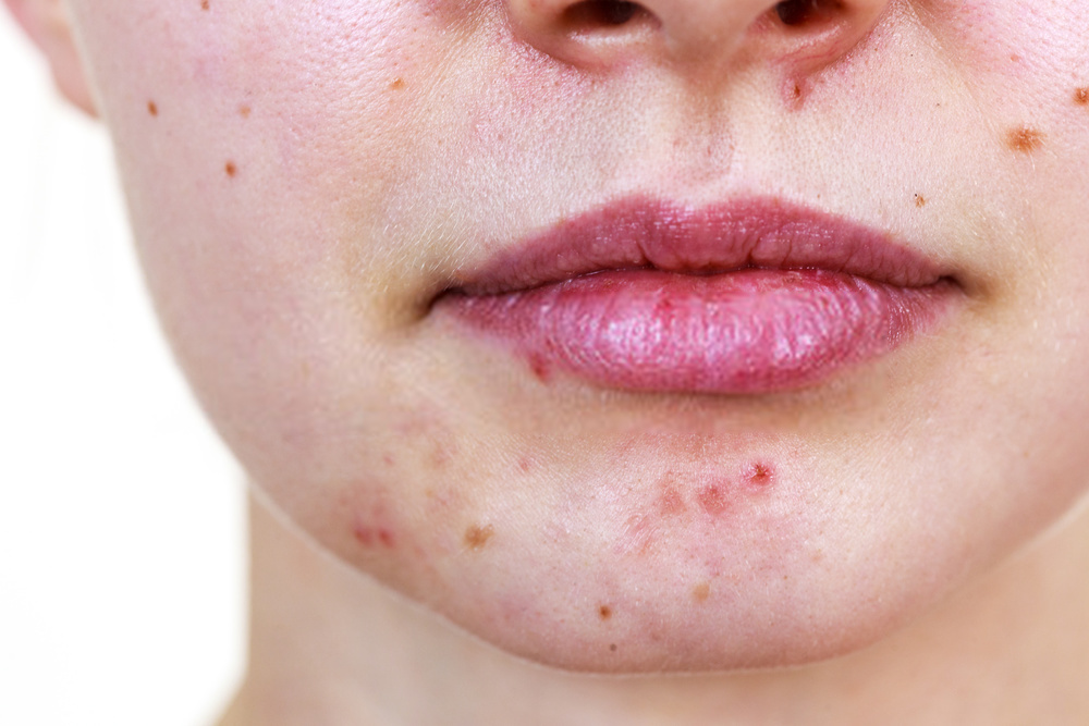 Causes of Chin Acne in Adults