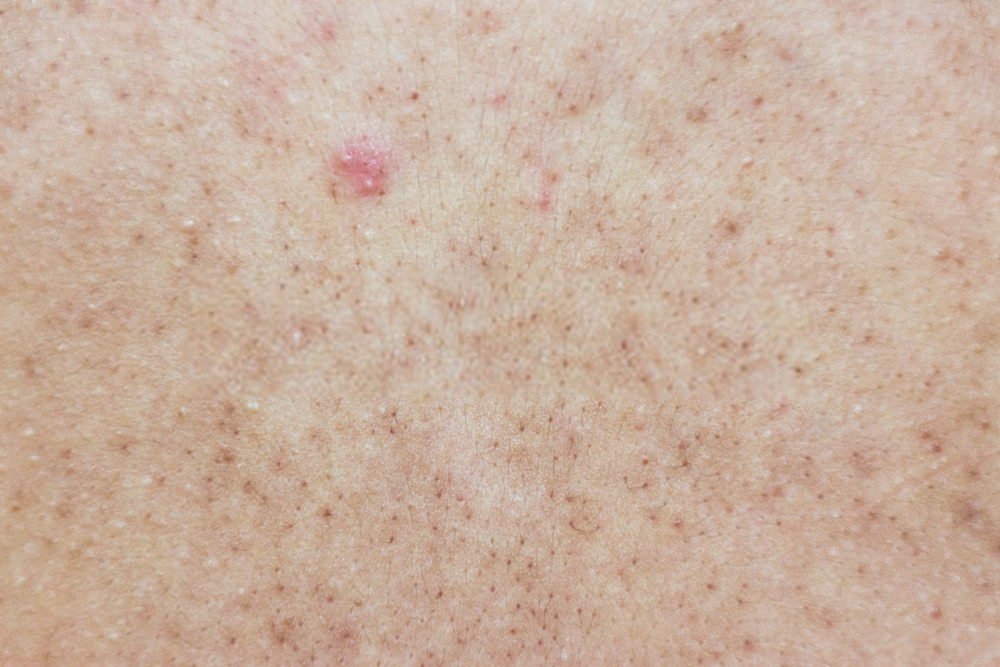 What Causes Blackheads on Back