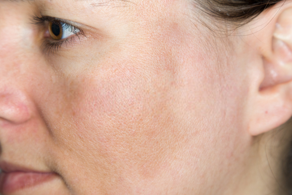 Skin Discoloration on Face Treatment