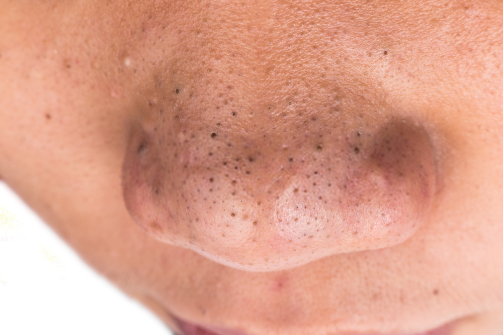 What Causes Whiteheads and Blackheads