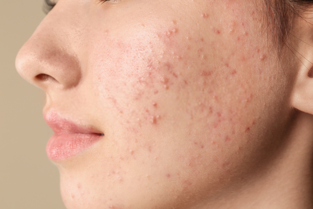 How to Prevent Acne on Cheeks?
