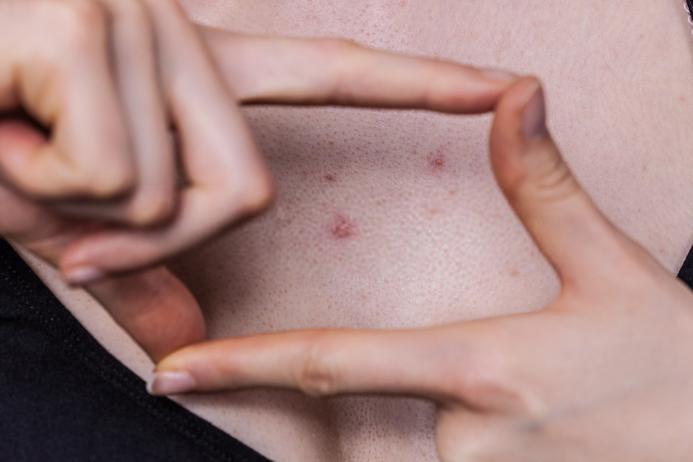 How to Stop Chest Acne?