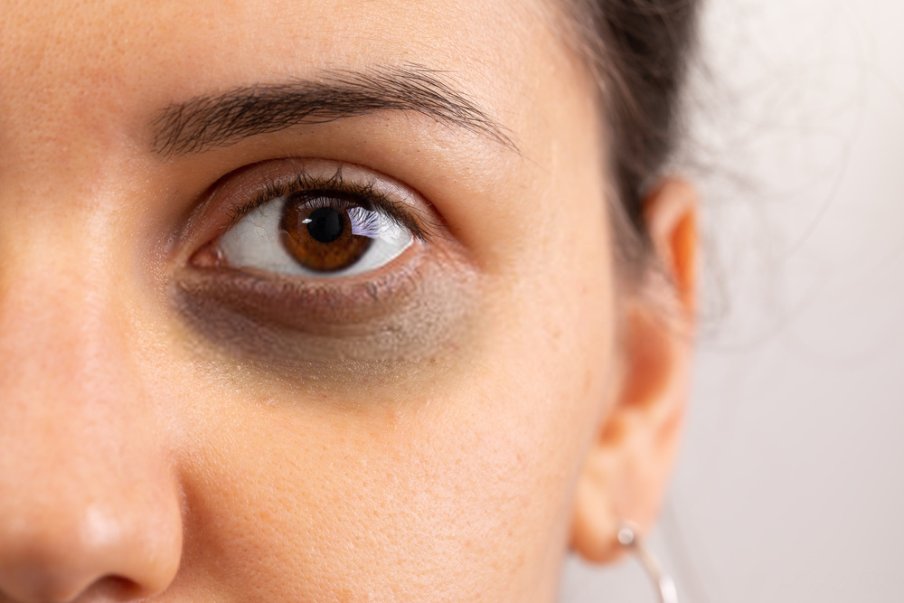 How to Lighten Dark Circles Around Eyes?