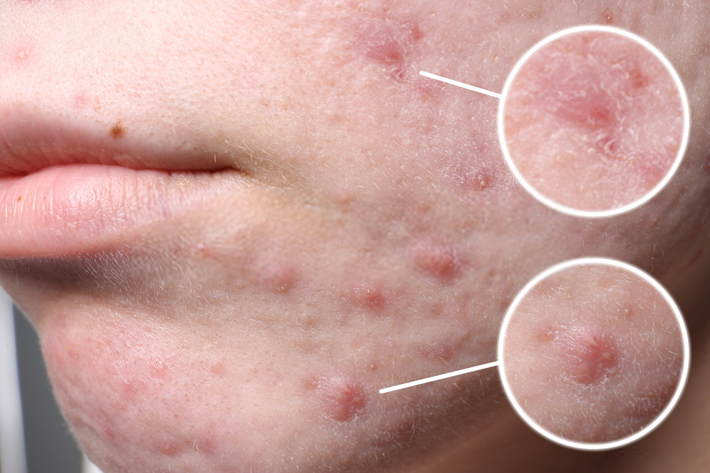 Causes For Pimples on Face