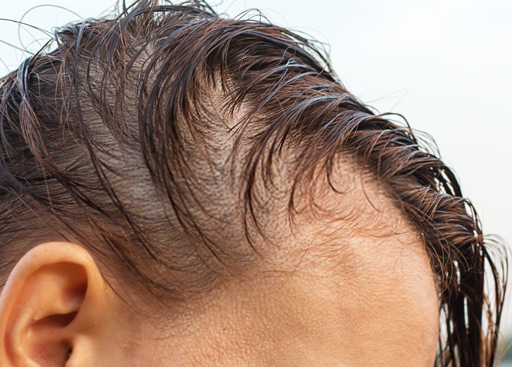 Hair Loss On One Side Of Head Female