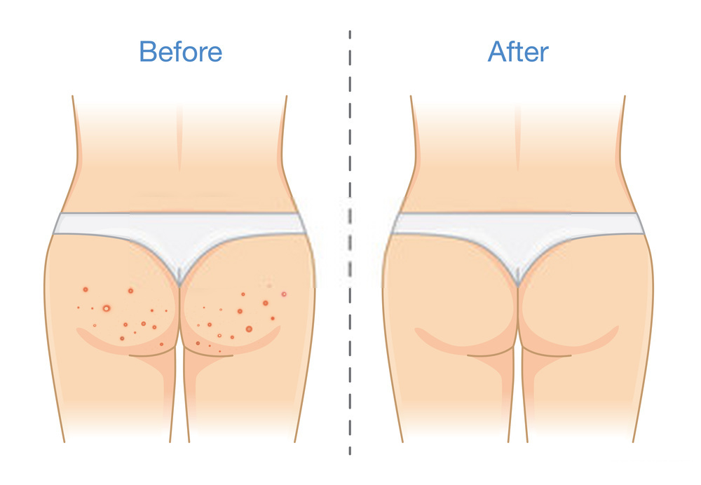 Buttock Acne Remedies