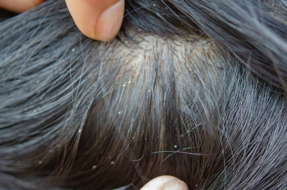 Symptoms of Lice in Hair