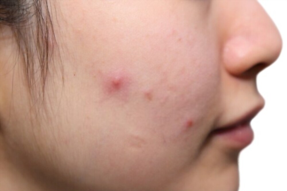 Cheek Pimples Treatment