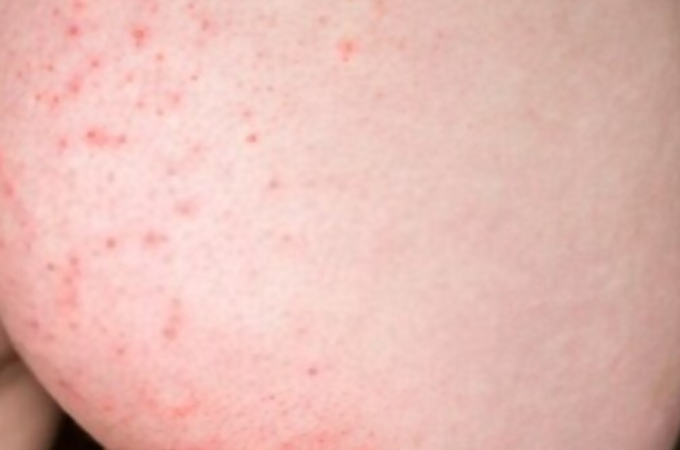 Red Bumps On Butt Cheeks