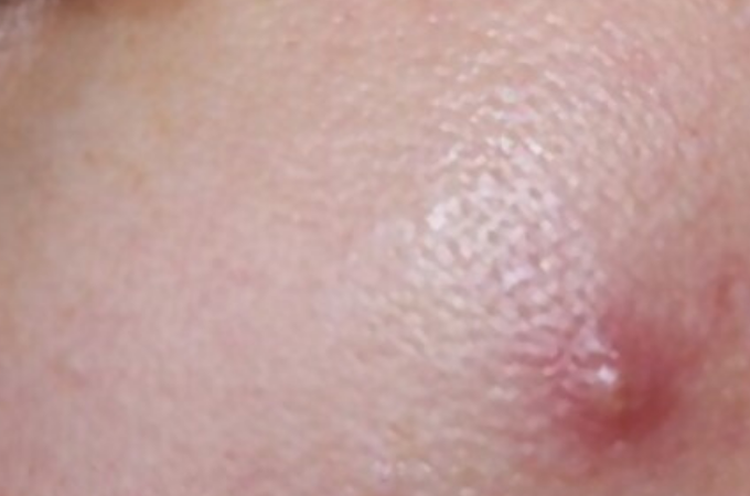 Cystic Pimple On Cheek