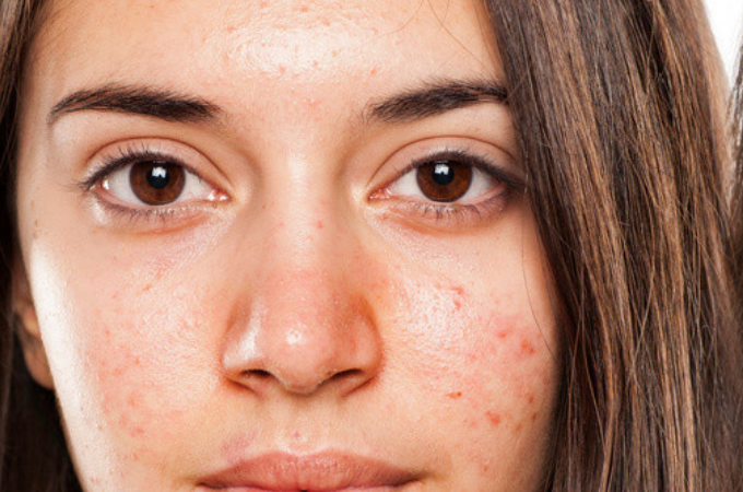 Red Pimples On Face Treatment