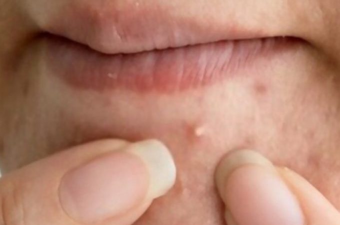 Tiny Bumps On Face