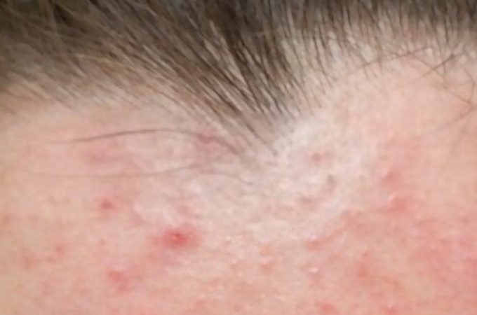 Pimple Solution At Home