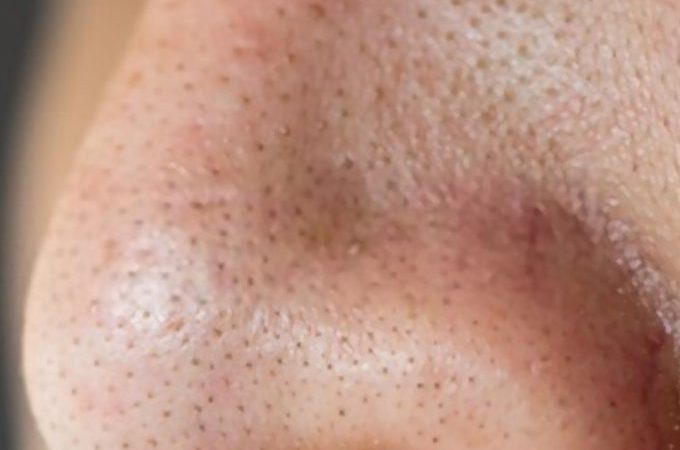 Home Remedies For Blackheads And Open Pores