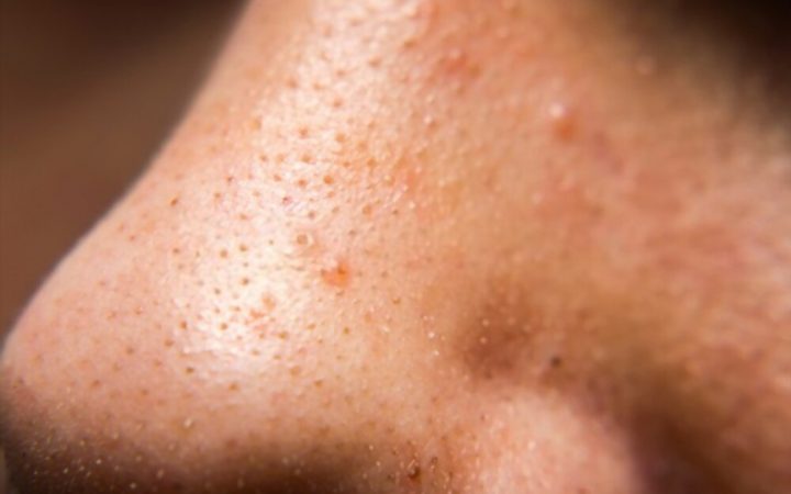 Blackheads And Whiteheads On Nose