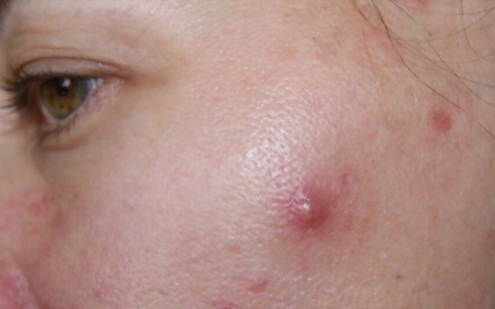 Cystic Pimple Treatment