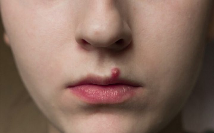 Pimples On Lips Treatment
