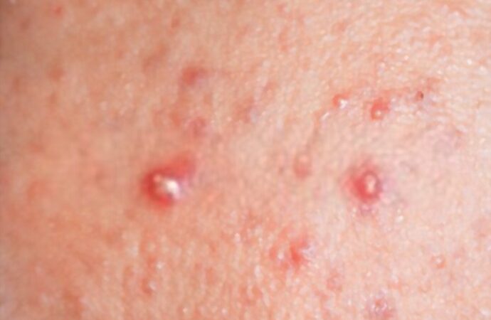 What Is Best Treatment For Pimples?