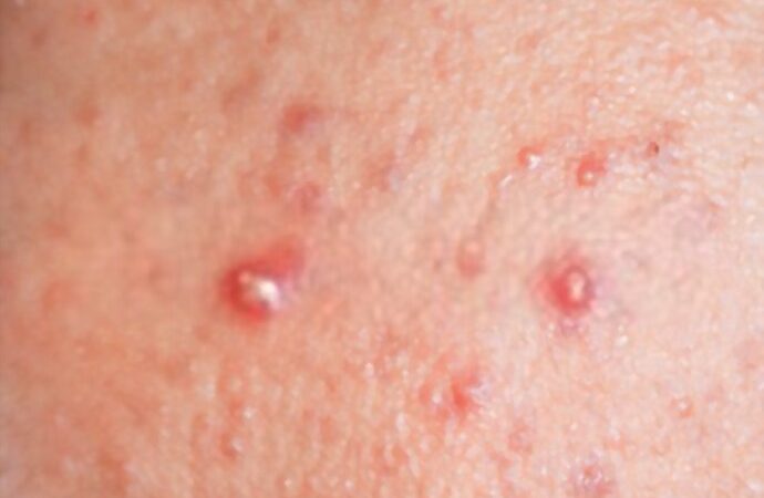 What Is Best Treatment For Pimples?