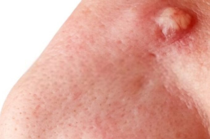 Cystic Acne On Nose Treatment