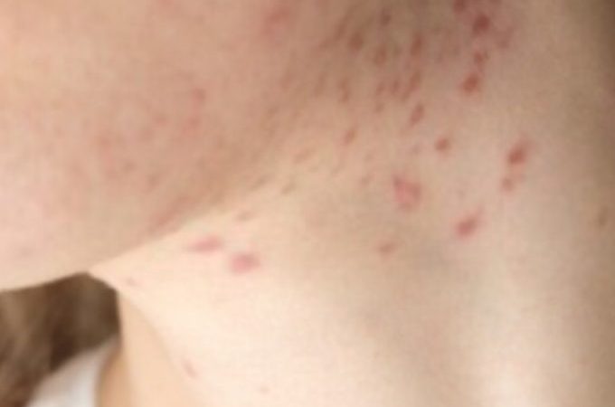 Cystic Acne On Jawline