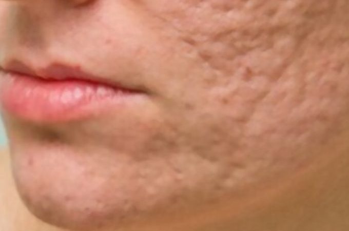 Acne Pits On Face