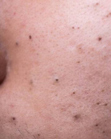 Blackheads Removal At Home