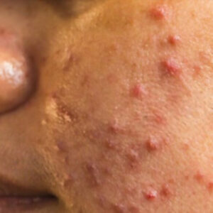 What Is Acne and What Causes It