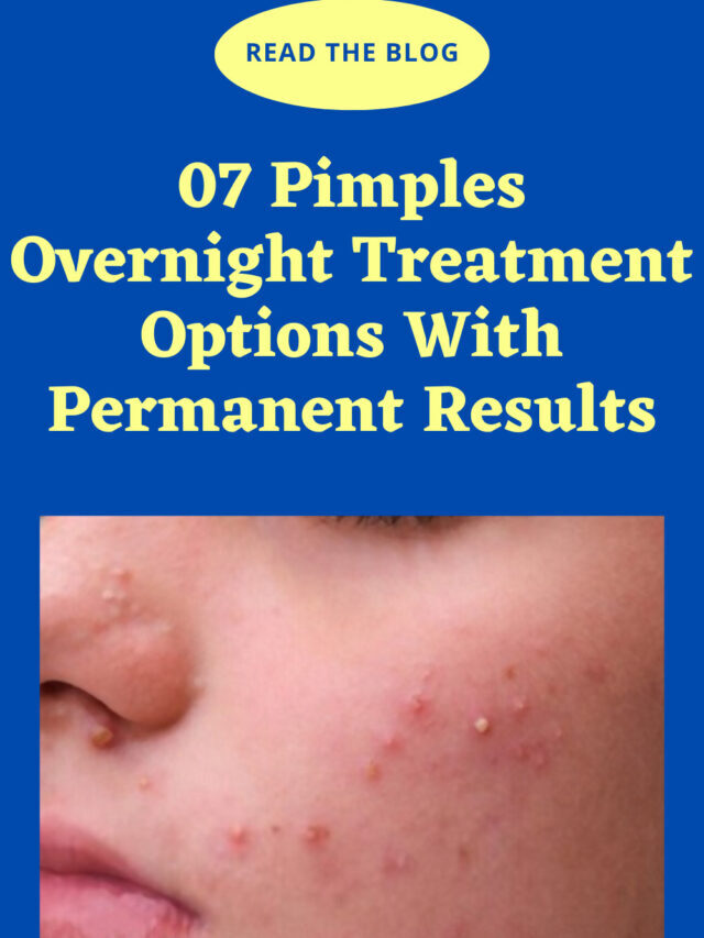 07 Pimples Overnight Treatment Options With Permanent Results