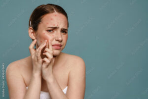 Effective Acne Skin Care Routine Acne Treatment